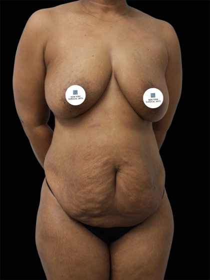 Tummy Tuck Before & After Patient #2891