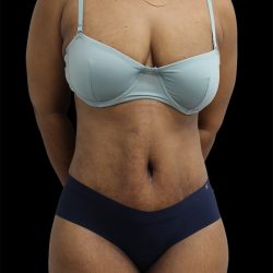 Tummy Tuck Before & After Patient #2891