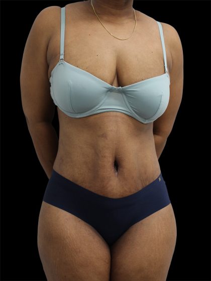 Tummy Tuck Before & After Patient #2891