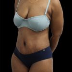 Tummy Tuck Before & After Patient #2891