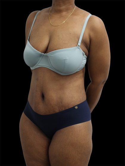 Tummy Tuck Before & After Patient #2891
