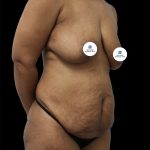 Tummy Tuck Before & After Patient #2891