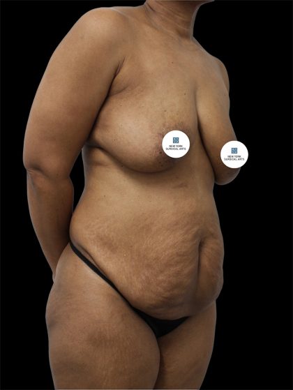 Tummy Tuck Before & After Patient #2891