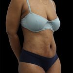 Tummy Tuck Before & After Patient #2891