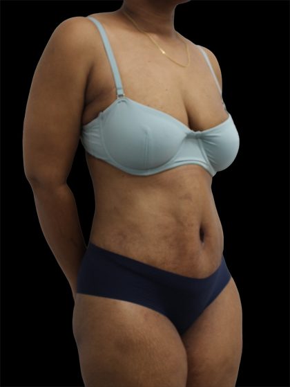 Tummy Tuck Before & After Patient #2891