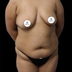 Tummy Tuck Before & After Patient #2892