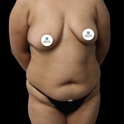 Tummy Tuck Before & After Patient #2892