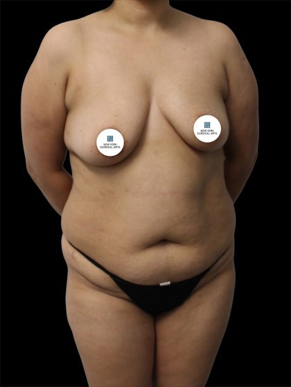 Tummy Tuck Before & After Patient #2892