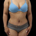 Tummy Tuck Before & After Patient #2892