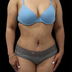 Tummy Tuck Before & After Patient #2892