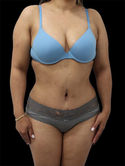 Tummy Tuck Before & After Patient #2892
