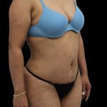 Tummy Tuck Before & After Patient #2892