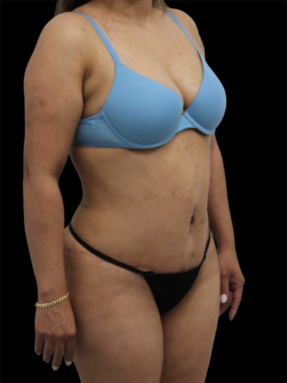 Tummy Tuck Before & After Patient #2892