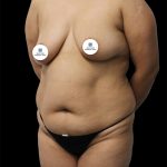 Tummy Tuck Before & After Patient #2892