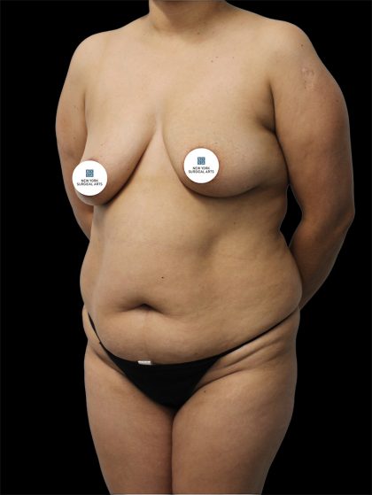 Tummy Tuck Before & After Patient #2892