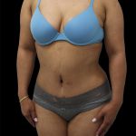 Tummy Tuck Before & After Patient #2892