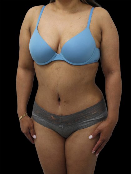 Tummy Tuck Before & After Patient #2892