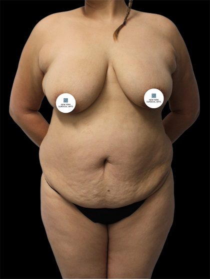 Tummy Tuck Before & After Patient #2893