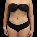 Tummy Tuck Before & After Patient #2893