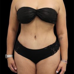 Tummy Tuck Before & After Patient #2893