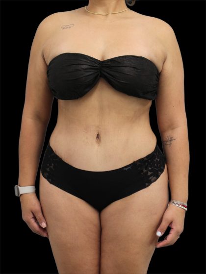 Tummy Tuck Before & After Patient #2893