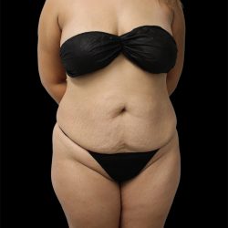 Tummy Tuck Before & After Patient #2691
