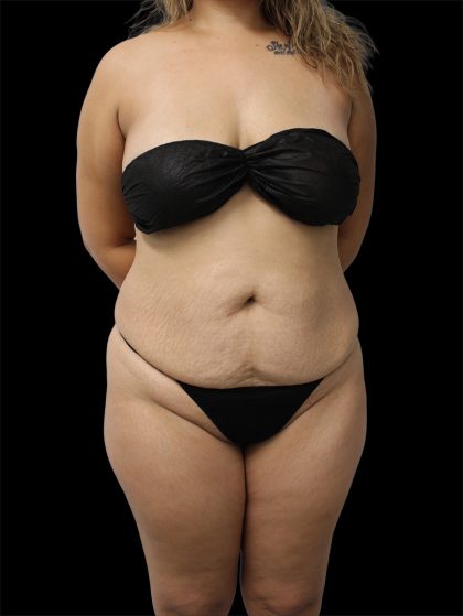 Tummy Tuck Before & After Patient #2691