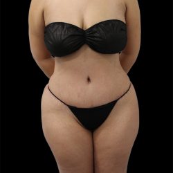 Tummy Tuck Before & After Patient #2691