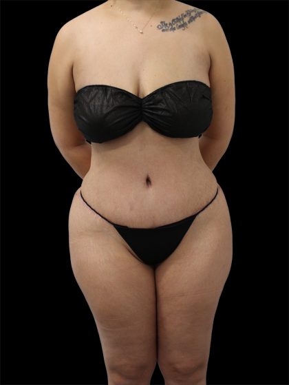 Tummy Tuck Before & After Patient #2691