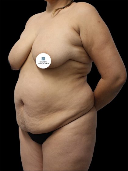 Tummy Tuck Before & After Patient #2894