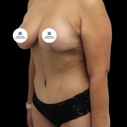 Tummy Tuck Before & After Patient #2894