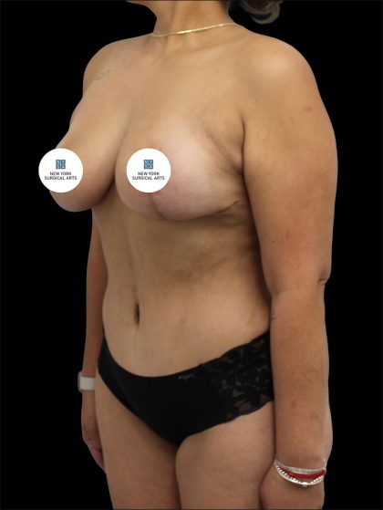 Tummy Tuck Before & After Patient #2894