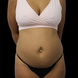 Tummy Tuck Before & After Patient #2692