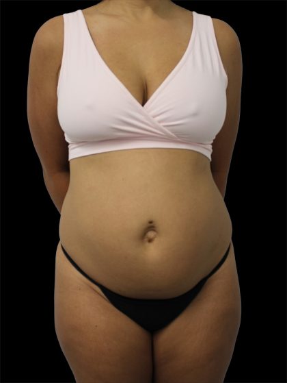 Tummy Tuck Before & After Patient #2692