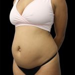 Tummy Tuck Before & After Patient #2692