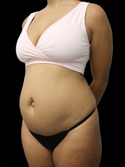 Tummy Tuck Before & After Patient #2692
