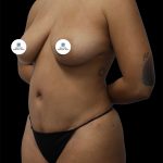Tummy Tuck Before & After Patient #2692