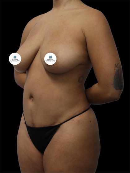 Tummy Tuck Before & After Patient #2692