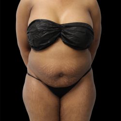 Tummy Tuck Before & After Patient #2693