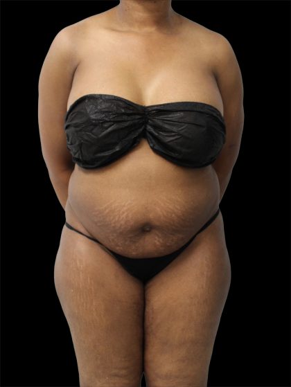 Tummy Tuck Before & After Patient #2693