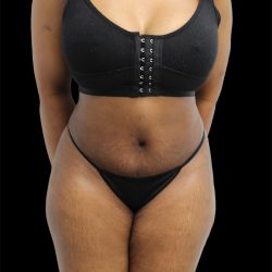 Tummy Tuck Before & After Patient #2693