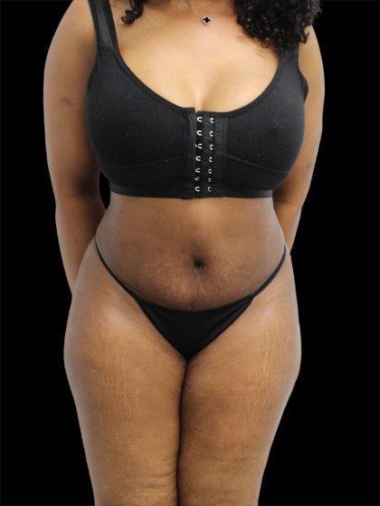 Tummy Tuck Before & After Patient #2693