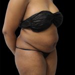 Tummy Tuck Before & After Patient #2693