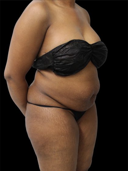Tummy Tuck Before & After Patient #2693