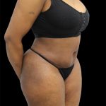 Tummy Tuck Before & After Patient #2693