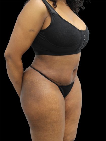 Tummy Tuck Before & After Patient #2693
