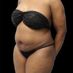 Tummy Tuck Before & After Patient #2693