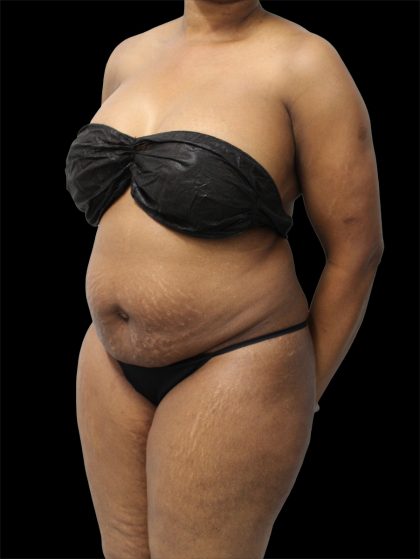 Tummy Tuck Before & After Patient #2693