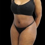 Tummy Tuck Before & After Patient #2693