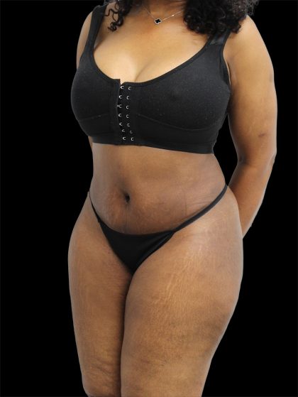 Tummy Tuck Before & After Patient #2693